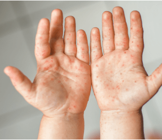 Mãos com sintoma de pés mãos boca