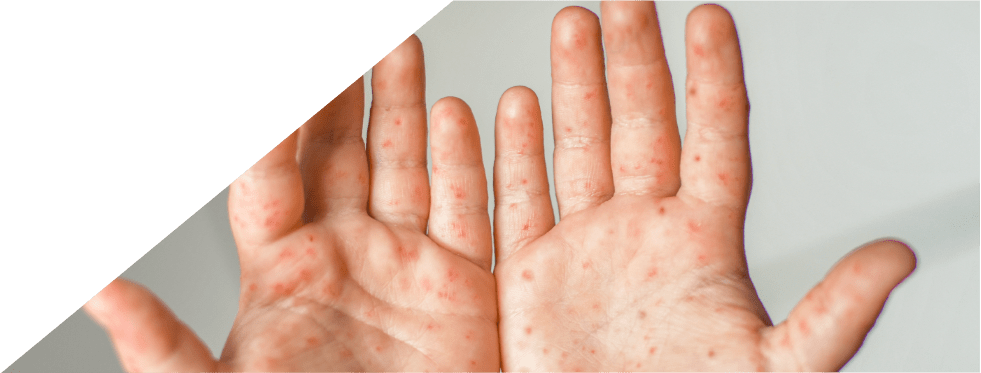 Mãos com sintoma de pés mãos boca